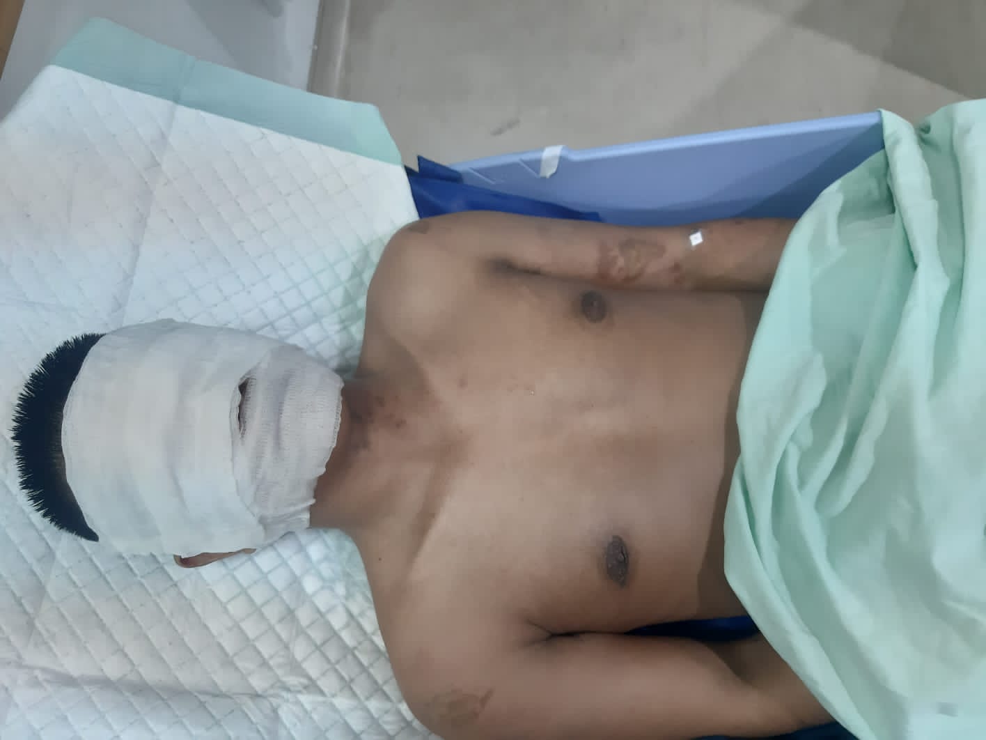 Sadis! Jurnalis Di Kota Medan Disiram Air Keras Oleh OTK