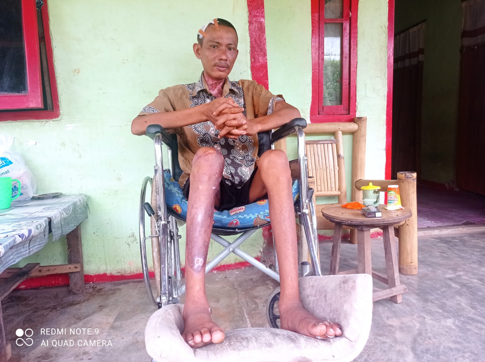 Tersengat Listrik Hingga Alami Kelumpuhan Warga Seluma Harapkan Uluran Tangan