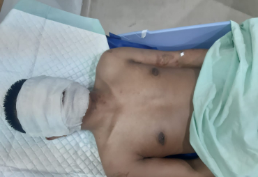 Sadis! Jurnalis Di Kota Medan Disiram Air Keras Oleh OTK