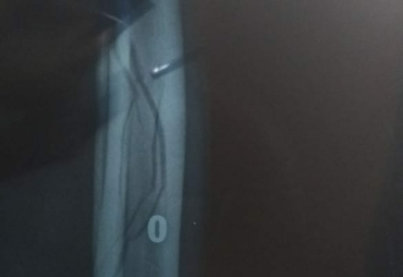 Hasil Rontgen Pertama 