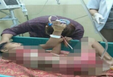 Ariana Menderita Luka Bakar Butuh Uluran Tangan Para Dermawan